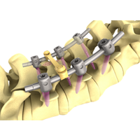 pine ii opfix plus脊柱內(nèi)固定系統(tǒng)