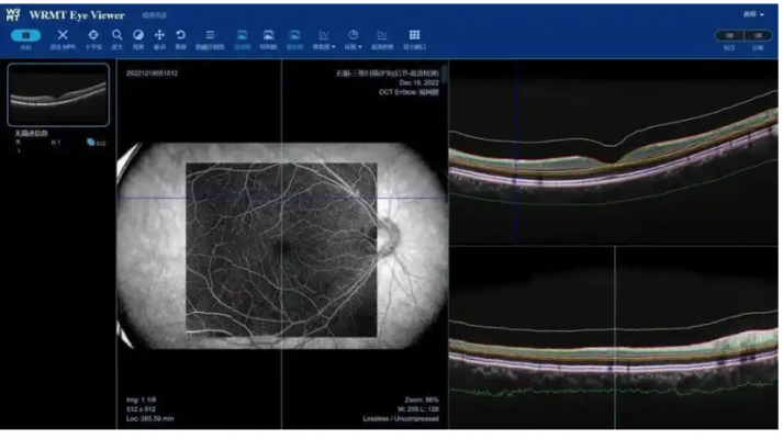 眼底病變眼底圖像輔助診斷軟件mcs（云服務器版）