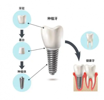 牙種植體基臺系統(tǒng) 春立正達(dá)