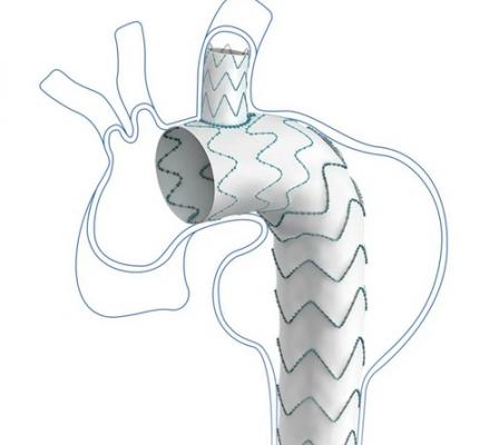 戈?duì)柗种托刂鲃用}覆膜血管內(nèi)支架系統(tǒng)gore