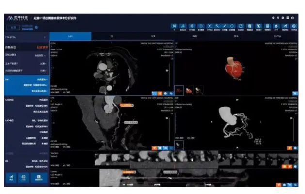 冠脈功能影像分析系統(tǒng)qfa 210