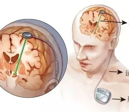 雙通道可充電植入式腦深部電刺激脈沖發(fā)生器套件